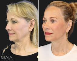 facelift at 50 before and after 